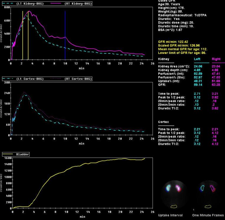 -. DTPA Gates 法 Renogram Review 画面 腎臓全体のカーブ 利尿剤投与時間 患者さま情報 本の黄色いロケータは UpTake 値計算の範囲を表します 腎臓皮質のカーブ 3 解析結果 膀胱のカーブ GFR(ml/min) 患者さまのGFR 値 Scaled GFR (ml/min)