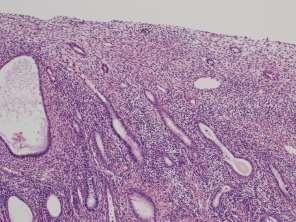 紡錘形核 細胞質なし 間質細胞凝集塊 腎形核 紡錘形核 細胞質なし 間質細胞凝集塊