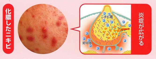 アクネ菌が増殖する の 3 つが挙げられますが ( 図 1) 特に 2 毛穴のつまりには乾燥が大きく関与します これは 皮膚の乾燥により 肌のバリア機能が低下するためです