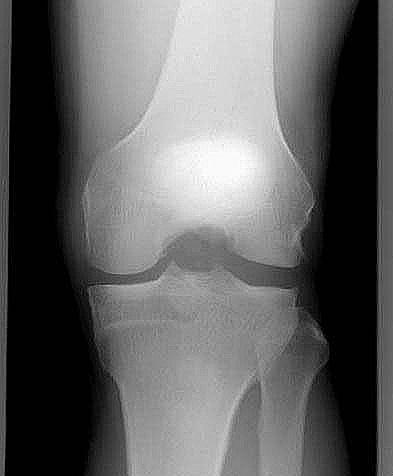 -54- 図 3 術後 MRI 撮影が可能であった6 膝において, 全例とも縫合部の輝度変化はなく, 新たな半月実質部の変性を生じた症例はなかった. 総合評価では,excellentが11 膝, goodが1 膝であった. 考察 半月は膝関節機能の維持に重要な役割を果たしている1).