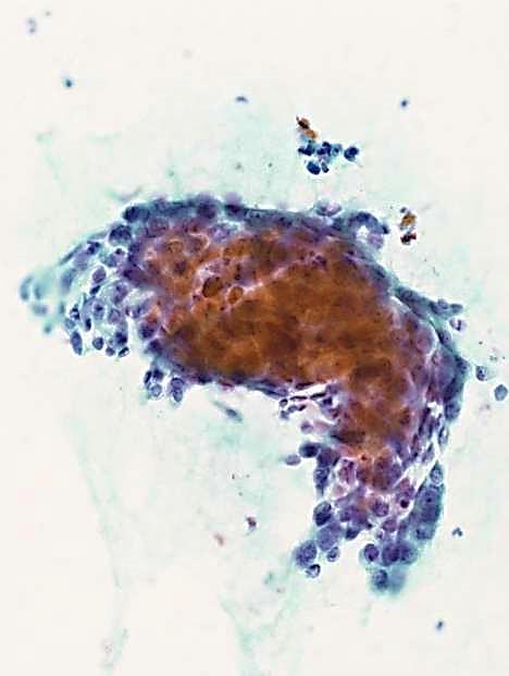 病理組織分類 大細胞癌 定義 大きな核