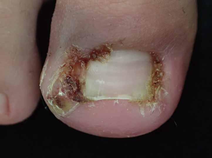 Ⅴ 足の外傷とスポーツ障害 かんにゅうそう ⑷ 陥入爪 陥入爪は爪の端が周囲の皮膚に食い込んで 皮膚に炎症を起こした状態です 爪だけが丸まっており 皮膚への影響がない巻き爪 (21 ページ図 33b 参照 ) とは異なります 主に足の親指に発症することが多く 皮膚は赤く腫にくげれ 痛みも伴います 過剰に肉芽が盛り上がって 出血を伴うことや傷から細菌が感染してうみそ膿を持つこと ( これを