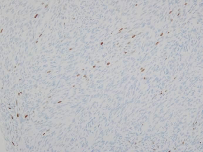 10 Vimentin がびまん性に腫瘍細胞の細胞質に陽性を示している.