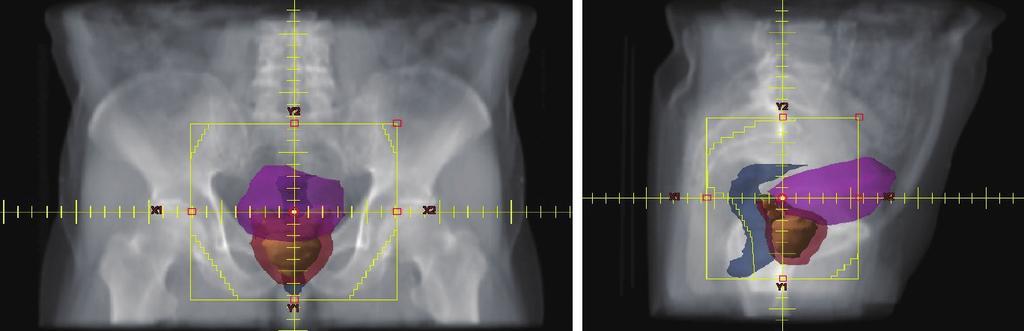 198 泌尿器 全骨盤への照射野の1例 黄 前立腺および精嚢 ピンク 膀胱 ブルー