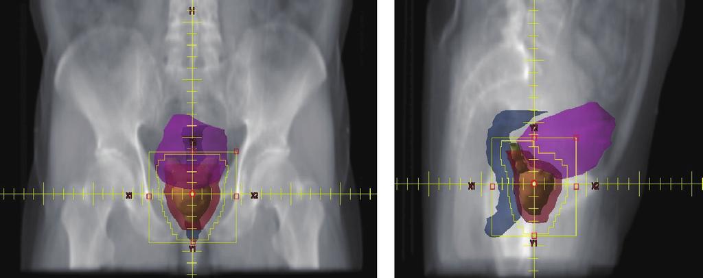 前立腺および精嚢の一部をCTVとした場合のPTV ピンク 膀胱 ブルー 直腸