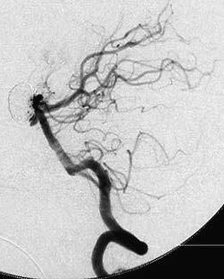 A Fig. 4 Postoperative angiograms show the neck remnant in the obliterated aneurysm with GDCs. The basilar and bilateral posterior cerebral arteries remain intact.