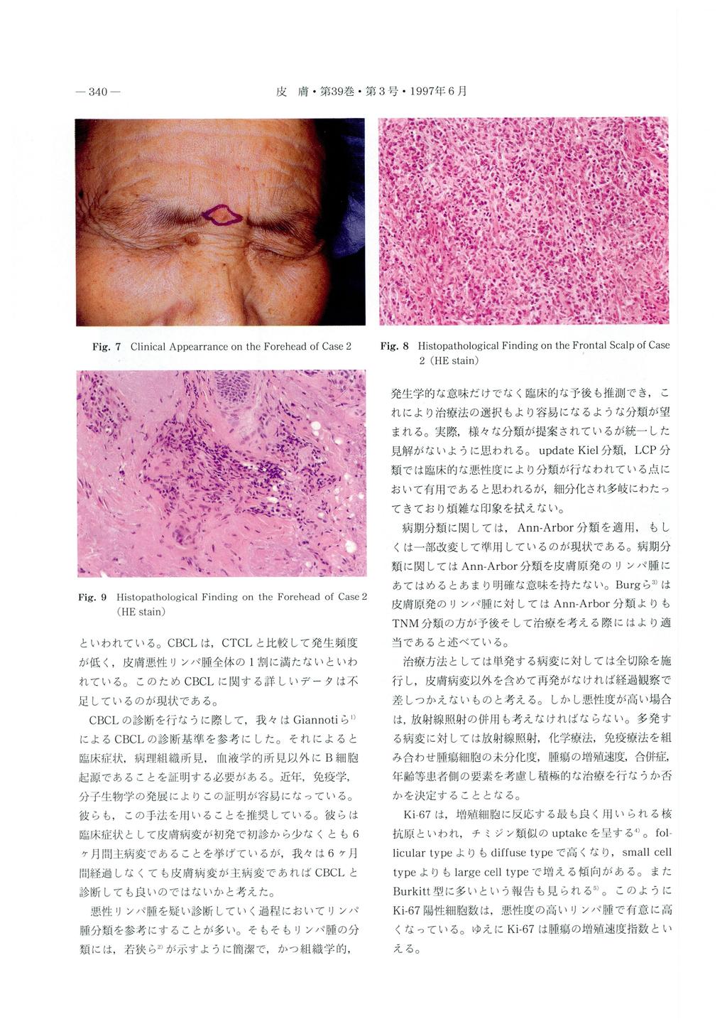 Fig. 7 Clinical Appearrance on the Forehead of Case 2 Fig.