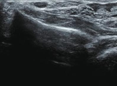 1. 掌側ロッキングプレート固定術後の長母指屈筋腱損傷 1 FPL