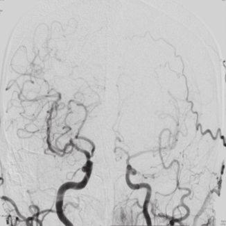 A: Diffusion-weighted magnetic resonance image on admission, showing acute cerebral infarction in the left frontal lobe.