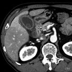 胆囊壁の造影不良 胆囊周囲膿 瘍 などに着目すべきである 急性壊疽性胆囊炎の特異的ダイナミック CT 所見は 胆囊壁の不整な肥厚 胆囊壁の造影不良