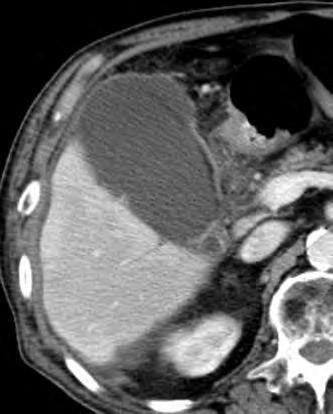 胆囊は腫大し 壁の濃染を認めるが 一部で壁の断裂 矢印 と壁在膿 瘍 矢頭 を認める 肝周囲に液体貯留 を認め 横隔膜下膿瘍と考えられる a 図 14