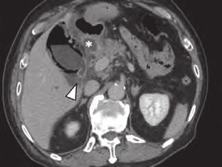 (*) と胆囊壁内のガス ( 矢印 ) である 単純 CT