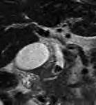 c MRI T 1 強調像では結石は明瞭な高信号を示す 矢印 d T