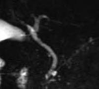 強調像冠状断では総胆管内に 2 つの低信号結節を認める d MRCP