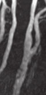 C: Three-dimensional angiograph showing a carotid artery dissection in the proximal portion of the CEA (arrow). The arrowhead shows a CEA portion.