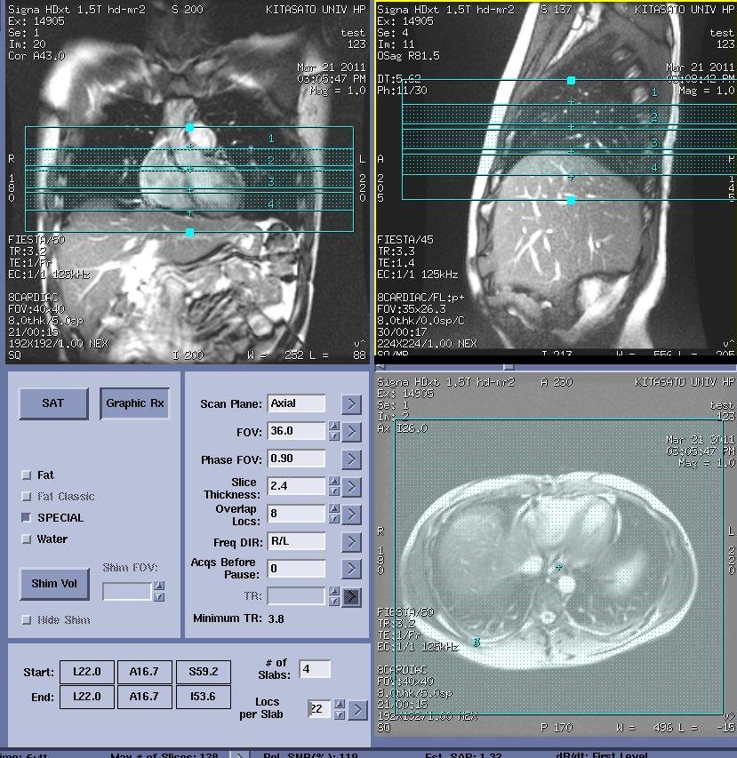 Chapter2: 検査の流れ - 3D Heart - 63D Heart の位置決め (Navi) 左右の Coronary