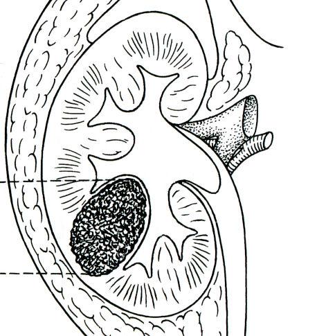 または副腎に浸潤, または腎周囲脂肪組織に浸潤するが,Gerota 筋膜を超えない