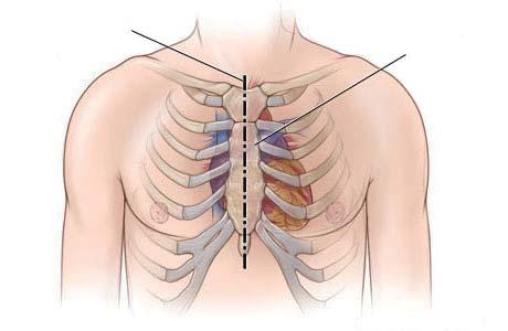 高度大動脈弁狭窄症の少なくとも 3 割以上の方が この治療を受けられていない現実もあります 胸骨正中切開 胸骨 狭窄した大動脈弁 人工弁 ( 機械弁 )