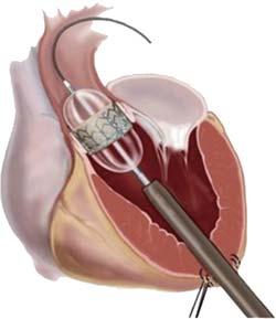 6. 経カテーテル的大動脈弁置換術 (TAVI) これまで 本来手術が必要とされる大動脈弁狭窄症患者の 3 割以上の方が 高齢であることや手術リスクが高いことから外科手術を受けられずにいました