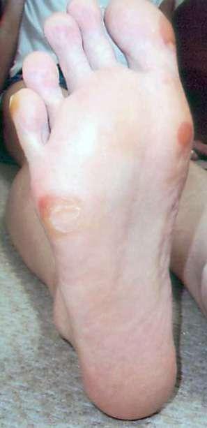 手足皮膚症候群 Hand-Foot-Skin Reaction(HFSR) Grade1 Grade2 Grade3 手