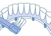 11 矯正用歯ブラシとインプラントブラシ CS708 インプラントオルソの活用 矯正中の歯磨きにはよりきめ細やかなお手入れが要求されます ブラケットとワイヤーに対しても完璧で定期的なクリーニングが必要です CSオルソそして CS708はそのお手入れに適しています CSオルソには特別な溝があり ブラケットを装着している場合でも歯磨きが可能です また CS708は
