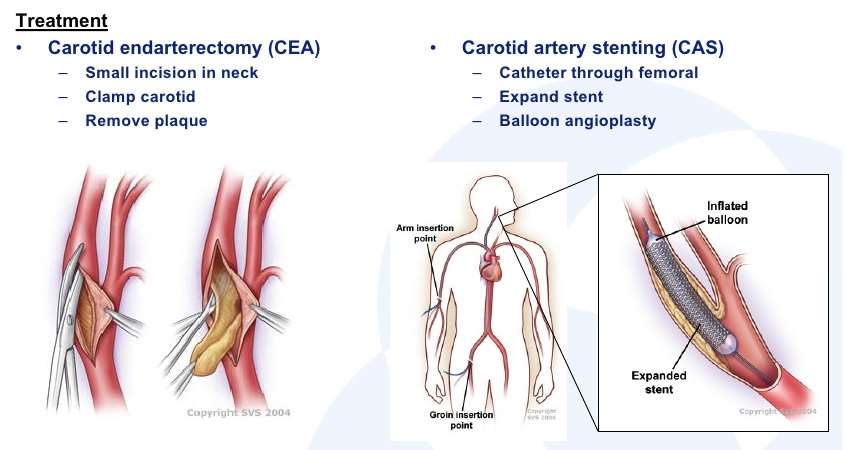 頸動脈狭窄の外科的な治療 CEA Source: