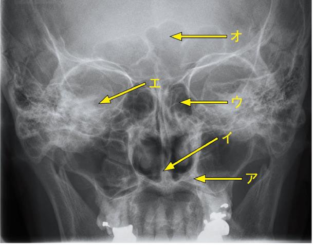問 79 副 鼻 腔 の 正 面 X 線 写 真 を 別 に 示 す 正 しい 組 合 せはどれか