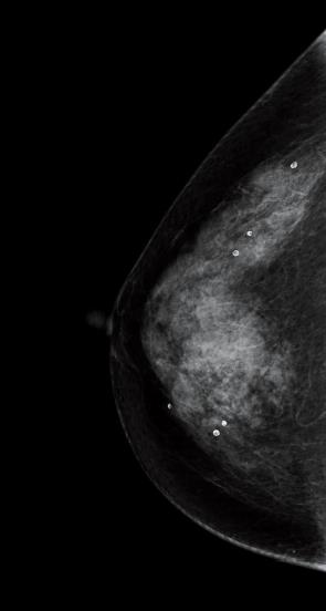 問 84 乳 房 X 線 写 真 を 別 に 示 す 所 見 で 正 しいのはどれか 1. 脂 肪 性 乳 腺 である 2.