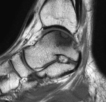 軟骨に対するアプローチ MRI 軟骨の評価 軟骨下骨の骨髄評価