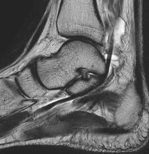 三角骨障害 ( 骨 骨髄 + 腱 ) 副骨障害の一つであり 距骨外側後方に発生 アキレス腱近傍の痛みを主訴とすることが多い 長拇趾屈筋腱