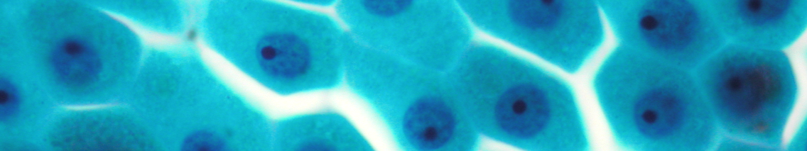顆粒も顆粒細胞腫と比べ明瞭でなく 顆粒細胞腫では顆粒は細胞質内へ全的にみられるのに対し アポクリン癌では顆粒を伴わない細 胞も存在する傾向にある 写真 7 8 三者の大きな鑑別点として 背景に飛散した顆粒があげら れ これらの所見より 鑑別は可能だと考える 乳腺の顆粒細胞腫は 臨床的に画像所見で悪性と 診断される場合もあり 注意を要する疾患で 今回 稀少例の設問として提示した 4