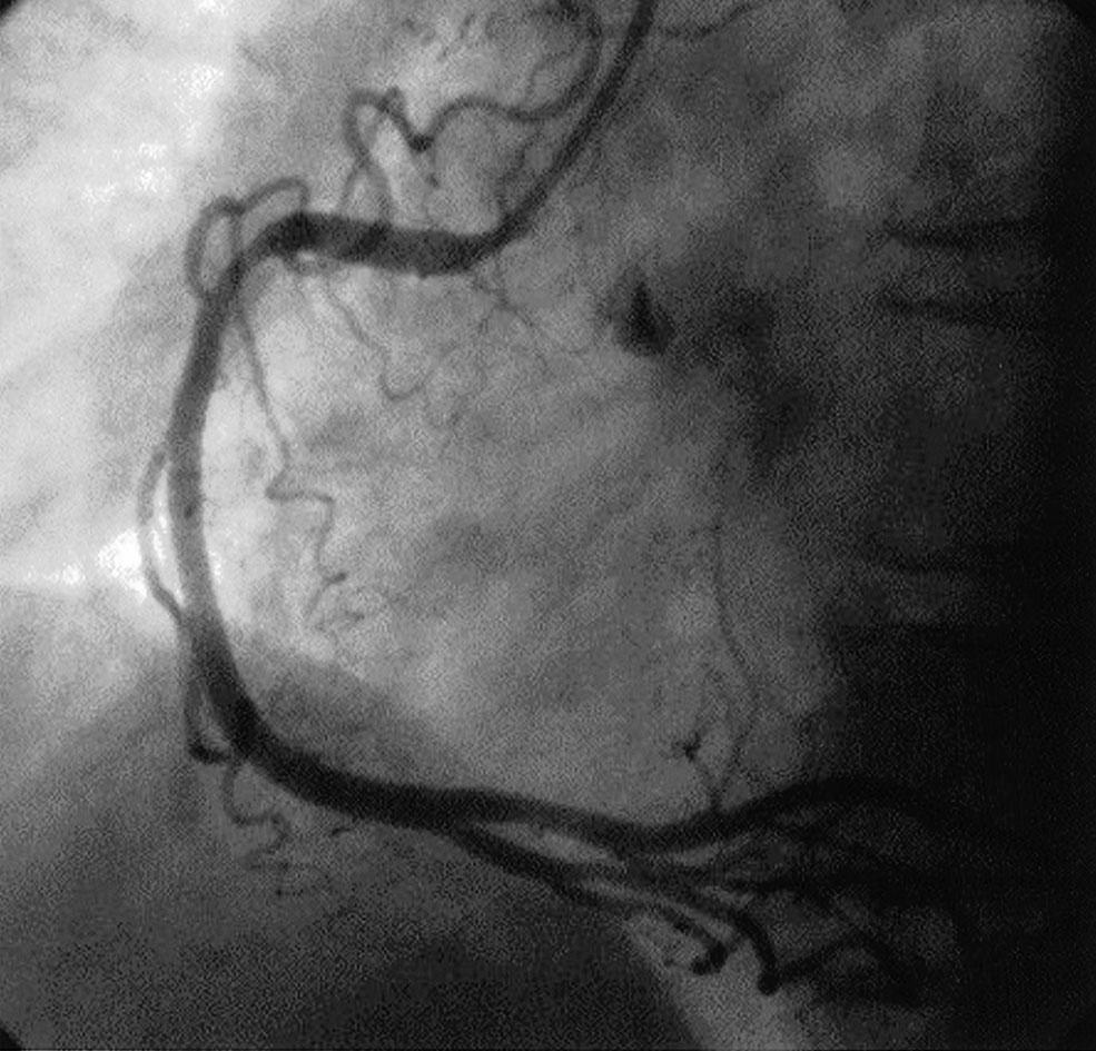 :Left coronary artery showing no significant