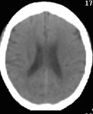 分の値を使用してSUVR 算出の指標とした 前頭葉 側頭葉 頭頂葉 後頭葉などの大脳皮質に同時に試行した頭部 CT
