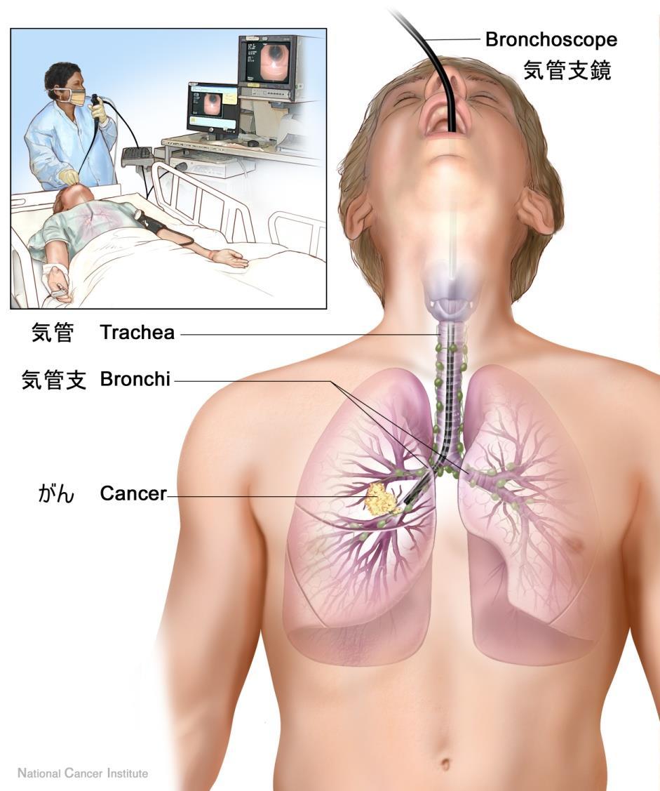 肺癌リキッドバイオプシー Ⅱ52.