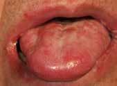 口の中の痛みが強くなって話せない 食べ物を飲み込めない 食事ができない 抗がん剤による口腔粘膜炎