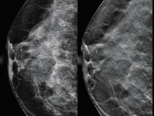 それによりがんの存在を強く疑うことが可能となる ( 図 7 図 8 図 9) これが乳房トモシンセシス 3D 画像の最大の利点である 2D 画像では 構築の乱れを spicula