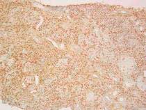多臓器病変 硬化性線維化 リンパ球 形質細胞の浸潤がありながら 血清 組織