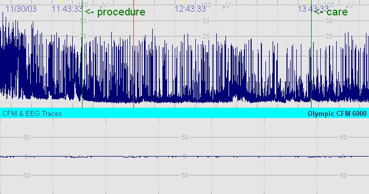 サンプル22: 高度異常のCFM EEGは ほぼ平坦な活動性