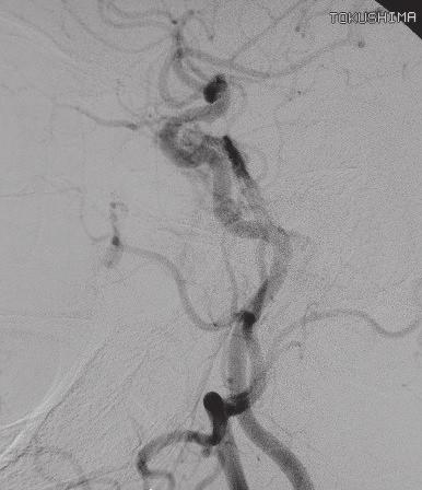 A and the sylvian vein drained into the cavernous sinus in the normal venous phase B, C.