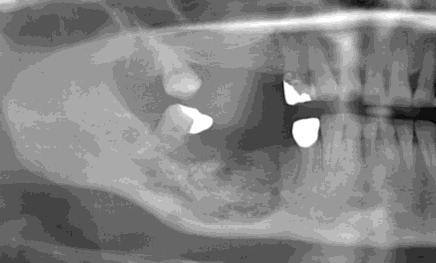 と鑑別すべき疾患を表 2 に示す がんの顎骨転移は BRONJ と鑑別すべき重要な疾患 であり 顎骨骨髄炎は BRONJ との鑑別診断が極めて困難である また ドライソケット ( 歯槽 骨炎 ) とは 抜歯窩に血餅が形成されず骨面が露出した状態が続いて強い痛みを伴うものを指す が BP 製剤投与患者の侵襲的歯科治療後にドライソケットが見られた場合は BRONJ に進展す る可能性がある (