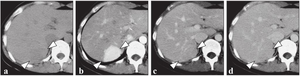 Fig. 2 Computed tomography of the liver a pre-enhancement b arterial phase of enhancement c portal phase of