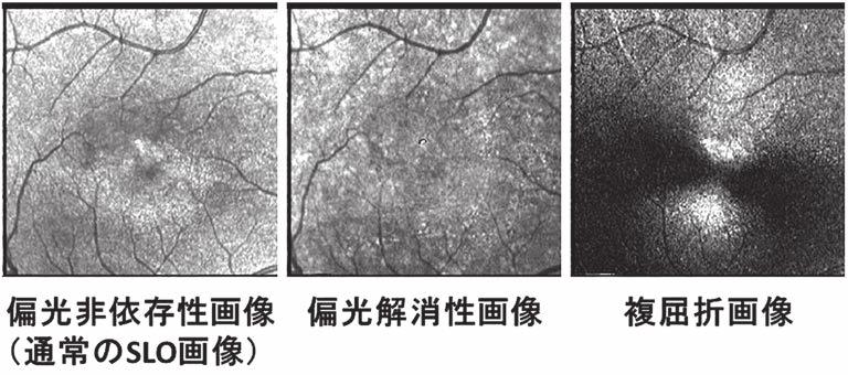 2018 4 三浦 : 黄斑疾患画像診断技術の開発 213 2 の SLO 画像 の