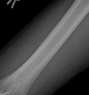 3 週間後 挫傷後上腕部異所性骨化 7 週間後