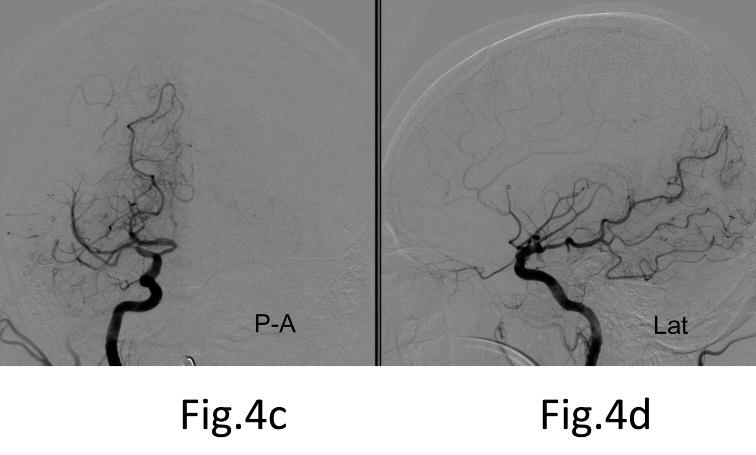 6a) 通常のアテローム血栓症では認められない所見ではあるもののMCA 皮質枝 2 本にバイパスを完成させた 術後 CTにおいても高度狭窄の中大脳動脈 M1
