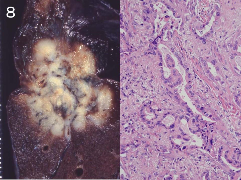 問 8 肺腫瘍の固定後のマクロ像 ( 左 ) とミクロ像 ( 右 ) 診断は?