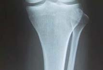 膝関節を内反させる力のモーメントが生じると膝関節内側コンパートメントへの荷重量が増加すると推測される ( 図 1-5) 1-16~1-18) 図 1-5 膝関節外反 内反と膝関節外側コンパートメント