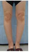 図 1-1 膝 OA 患者の立位膝関節正面の X 線写真画像 膝 OA の治療は, 観血的治療と保存的治療に大別され, 大多数は保存的治療が適応とされる 1-11) 大森 1-12) は, 日本の一地域における 28 年間におよぶ長期縦断疫学調査により, 膝 OA の進行は緩徐であり, 約 30 年の経過で手術に至るのは 10% 以下であったと報告した このことは, 膝 OA