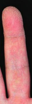 dyshidrosis 図 8 異汗性湿疹の臨床像 小指球と母指球に 帽針頭大の小水疱が集簇性に多発している 異汗性湿疹 上述 と同一の病態であり 軽症病変と考え られている 4 おむつ皮膚炎 diaper