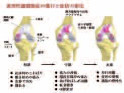 膝関節自体に対する治療の中では 大腿四頭筋訓練が非常に重要な治療となります さらに 膝関節に動揺性がある場合は 装具療法も必要になります