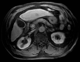細胞造影相プリモビスト造影剤による MRI 画像の経時的変化肝造影剤注入後の時間経過 5 分後 10 分後 15 分後